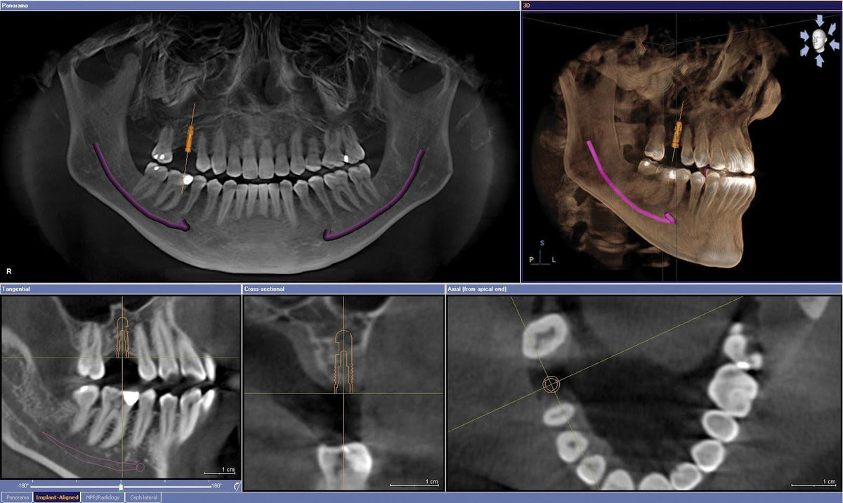 Tomógrafo de haz cónico (CBCT)