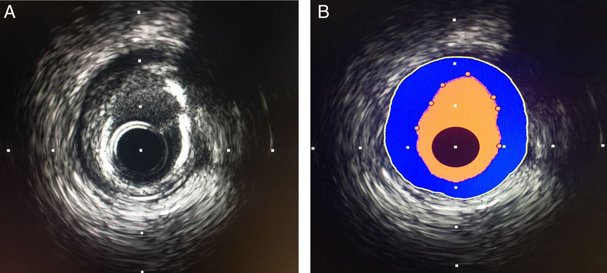 Ultrasonido intravascular