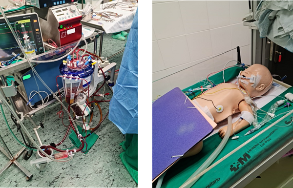 Dispositivo de soporte vital extracorpóreo (ECMO)