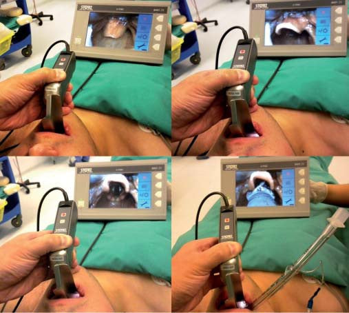 Laringoscopio de video